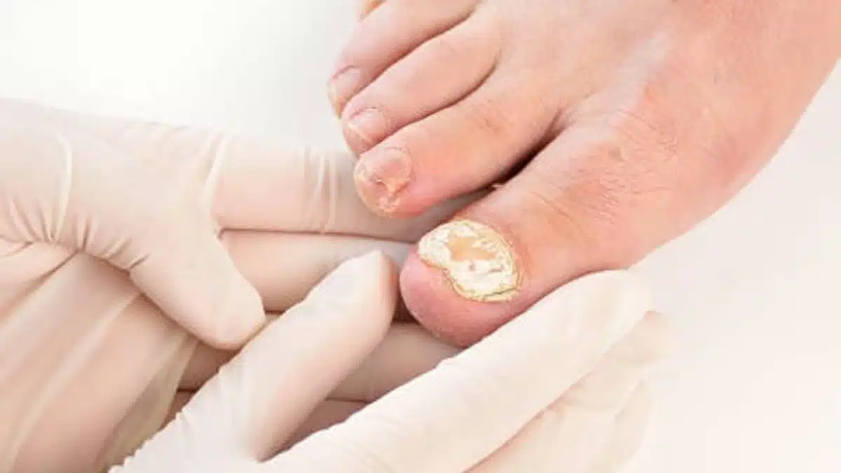 Unha do pé com micose visível sendo examinada por profissional com luvas.