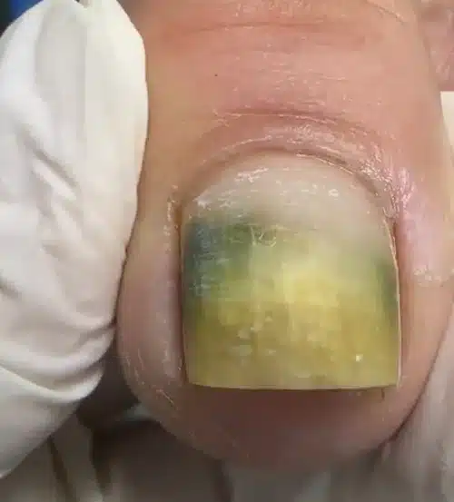 Unha com micose apresentando coloração amarelada e esverdeada.
