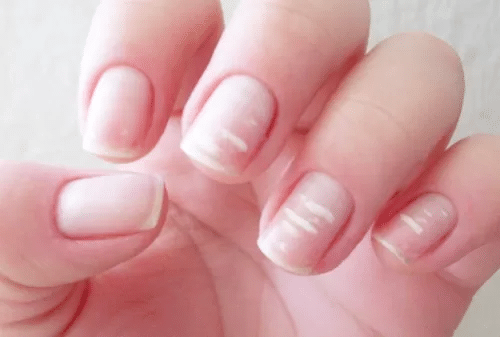 mãos femininas com unhas com manchas brancas