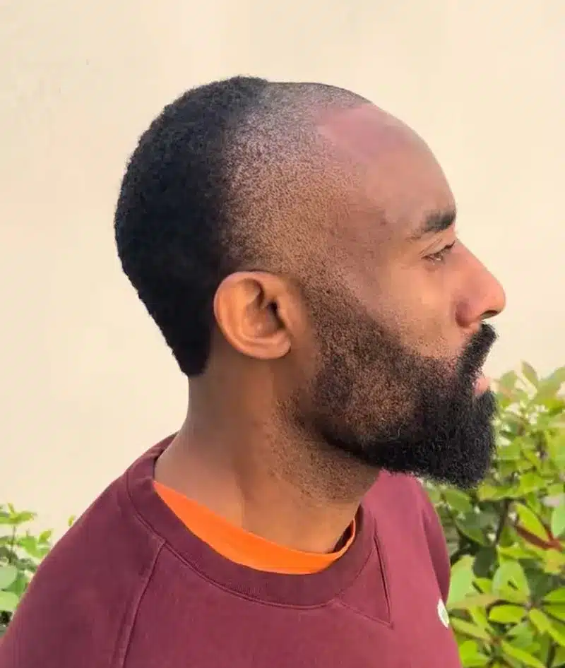 Homem com corte de cabelo meio calvo, tendência masculina de 2025.