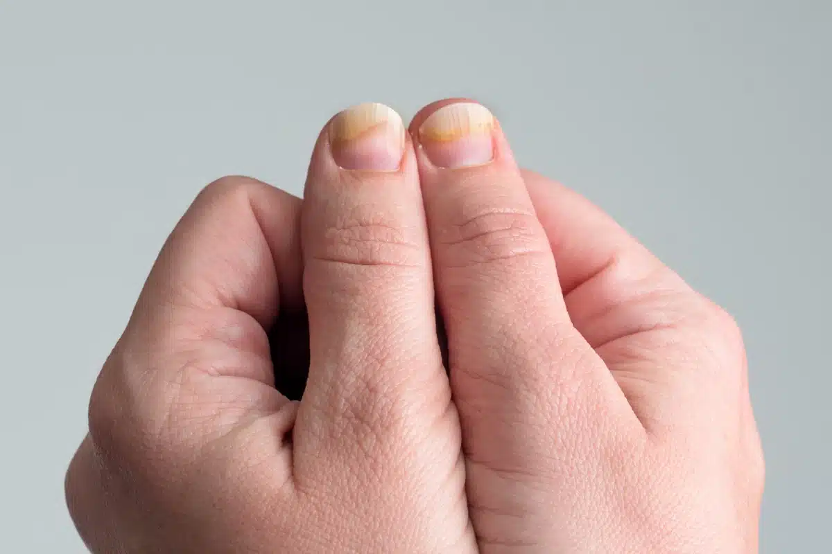 Unhas com manchas amarelas e aspecto desgastado, mostrando necessidade de cuidados e tratamento.