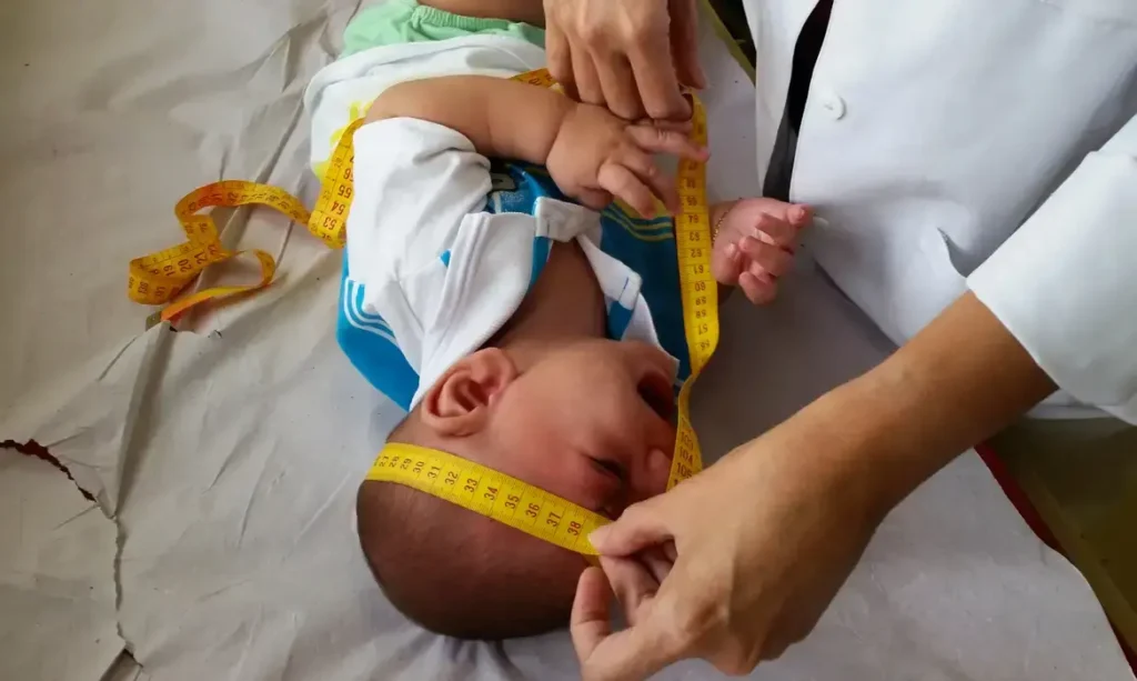 Criança com sequelas do Zika recebendo apoio do INSS por meio de indenização e pensão vitalícia.
