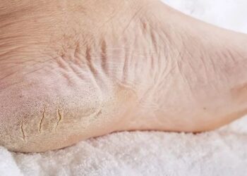 Pé com rachaduras visivelmente.