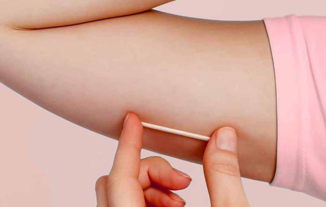 Close do braço de uma mulher mostrando o posicionamento do Implanon, um pequeno bastonete flexível inserido sob a pele para contracepção de longa duração.